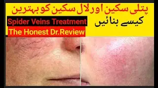 Spider veins treatment | patli skin ki problem ko solved Kry | the honest Dr review...