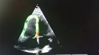 2D Speckle Tracking Strain of RV in patient post Fibrinolytic Acute Pulmonary Embolism 