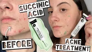 BEST NEW ACNE TREATMENT | TESTING THE INKEY LIST SUCCINIC ACID ON MY ACNE FOR 2 WEEKS