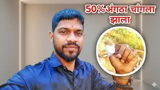 Vlogs14 अंगुठा 50% चांगला झाला ll   #dailyvlog 