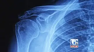 6abc Art of Aging: Joint Problems in Women