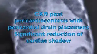 Pericardial effusion