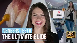 Your Ultimate Guide to Having Veneers teeth in Turkey