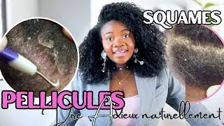 PELLICULES, D&Eacute;MANGEAISONS, SQUAMES || Comment s'en d&eacute;barrasser des  pellicules ?