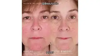 Rodan and Fields Soothe Regimen Review: Does It Really Calm Sensitive Skin and Reduce Redness?