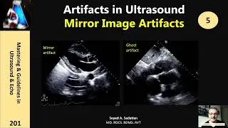 Artifacts in Ultrasound 5: Mirror Image Artifact