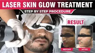 Laser Skin Glow Treatment | Step by Step Procedure | Sakhiya Skin Clinic