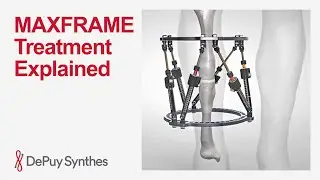 Fundamentals of Treatment with the MAXFRAME Multi-Axial Correction System | DePuy Synthes