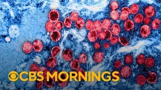 WHO declares mpox outbreak in Africa a global health emergency