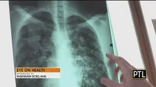 Eye On Health: Lung Cancer Awareness Month