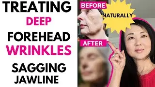 Treating Deep Forehead Lines and Sagging Jawline  #goseechristy