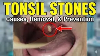 Tonsil stones .  Causes,removal & prevention
