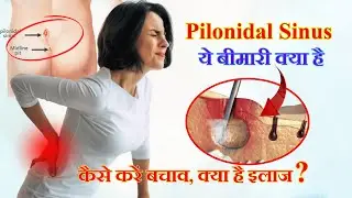 Pilonidal Sinus Kya Hai in Hindi? Pilonidal Sinus se Bache | Pilonidal Sinus Bimari Ka Ilaj in Hindi