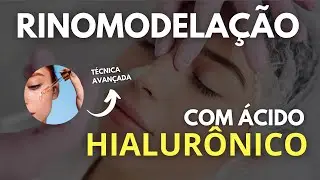 RHINOMODELING WITH HYALURONIC ACID