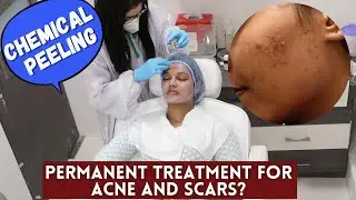 I got STRONG Chemical Peeling at the Clinic for ACNE | Is it a Permanent cure?#SkinTalkWSarah EP 20