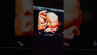 4D Ultrasound of Mylus (my grandson) !! #4dultrasound