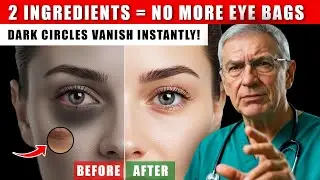 How to Remove Dark Circles Naturally | Coffee + Honey Eye Mask That Works Instantly