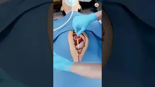 Scissors Left In His Stomach For 18 Years 😱 3d Animation video #shorts