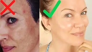 GET RID OF HYPERPIGMENTATION,  MELASMA & DARK SPOTS! What your Dr may NOT be telling you!