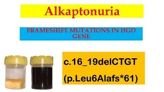 Alkaptonuria Part 3; How HGD Gene Mutations Cause Alkaptonuria | Frame Shift Explained