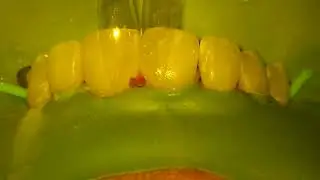 Closing Spaces Between Front Teeth   Bioclear Technique