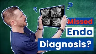 Why doctors miss the diagnosis for endometriosis
