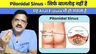 Pilonidal Sinus is not just a fistula, it can also be an anal fistula.