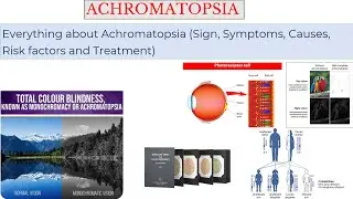Achromatopsia_ Causes, Risk factors, Etiology, Sign, Symptoms and treatment of color blindness.