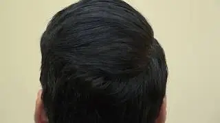 Bald Crown Vertex Hair Transplant Restoration Surgery Results Dr. Diep  