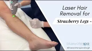 Laser Hair Removal for Strawberry Legs