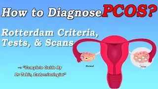 How to Diagnose PCOS | Complete Rotterdam Criteria & Test Guide (Urdu / Hindi)