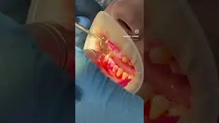 Профчистка зубов методом Air-Flow в New Dent 🦷🤍 #newdentsaransk #профчистка #airflow #saransk