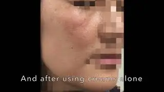 Management of Melasma