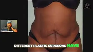Critical Tummy Tuck Tips: Spotting Hernias with Confidence