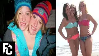10 Longest Living CONJOINED TWINS | TWO GIRLS ONE BODY | FACT CENTRAL