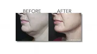 Nonsurgical Skin Tightening with Quantum RF | Quantum RF in Oak Ridge, TN
