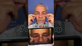 JW Hospital rejuvenates eyes by 10 years, removing age-related eye bags for an 80-year-old Americ...