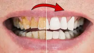 Отбеливание зубов в домашних условиях за 2 МИНУТЫ 💥 (Легкий метод) 🤯