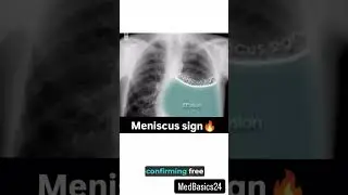 Meniscus Sign in Pleural Effusion | Radiology Basics #medicalshorts