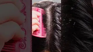 МОЖНО ЛИ ИЗБАВИТЬСЯ ОТ ПЕРХОТИ ?