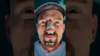 &ldquo;What Happens When Your Nose Breaks? | Nose Fracture Treatment Explained&rdquo; #shorts #facts