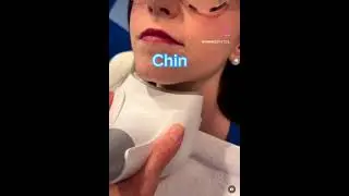 CoolSculpting Areas