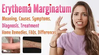 Erythema marginatum overview, meaning, signs and symptoms, diagnosis, treatment, home remedies, FAQs