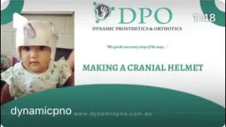 How a Cranial Helmet is made