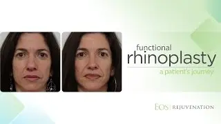 Functional Rhinoplasty at Eos Rejuvenation with Dr. Nima Shemirani