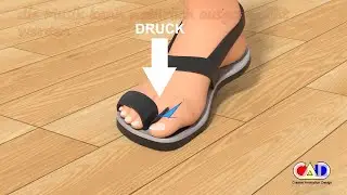 Schuh gegen Hallux valgus Medical device 3d animation