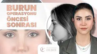 Ece's Rhinoplasty Experience with Dr. Muhammet Dilber