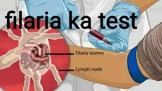 Microfilaria की जांच कब और कैसे की जाती है