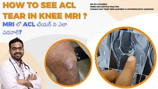 How To See ACL Tear In Knee MRI ? Dr Sai Chandra