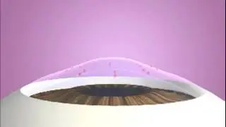 Conductive Keratoplasty (CK)